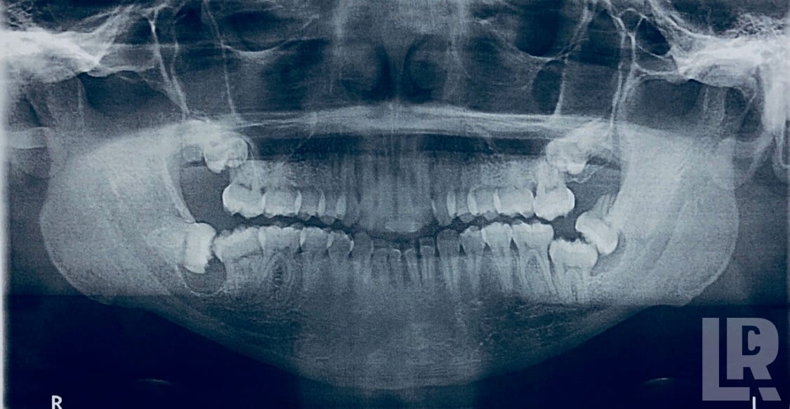 Panoramic dental radiograph showing full dentition and jaw